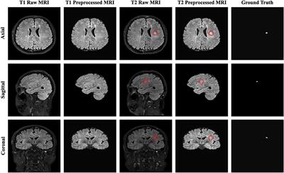 New MS lesion segmentation with deep residual attention gate U-Net utilizing 2D slices of 3D MR images